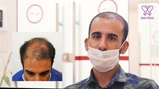 رضایت کاشت مو