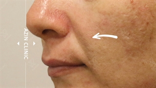 تزریق ژل خط خنده و زیرچشم
