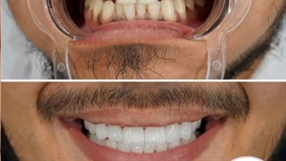 فیلم لمینت دندان آر اف فرکشنال