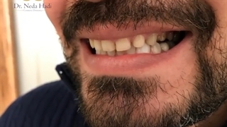 تاثیر شگفت انگیز لمنیت در زیبایی دندان ها