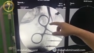 جراحی دیسک گردن