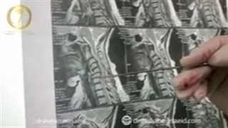 جراحی آسیب نخاعی