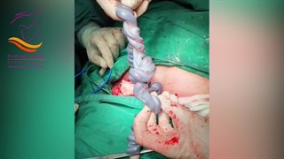زایمان سزارین نوزاد 36 هفته