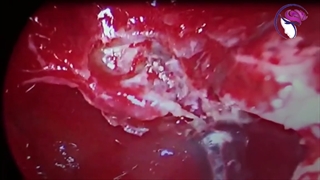 فیلم آندوسکوپی درمان نشت مایع مغزی نخاعی