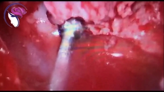 فیلم جراحی نشت مایع مغزی در دختر 23 ساله