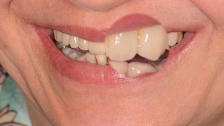 ایمپلنت دندان