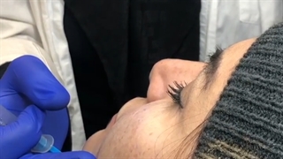 مزوتراپی لاغری صورت
