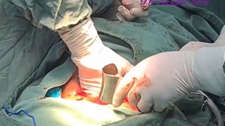 موضوع : زایمان سزارین