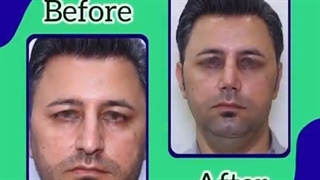 جراحی بینی مردانه ( ساده و طبیعی )