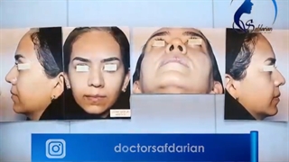 جراحی بینی  نیمه فانتزی + توضیحات پزشک