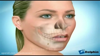 ارتودنسی ثابت و جراحی فک بالا