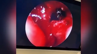 فیلم واقعی اتاق عمل جراحی آندوسکوپی سینوزیت چرکی