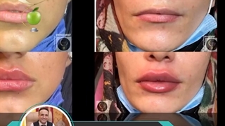 نمونه کارهای تزریق ژل لب