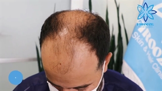 فیلم واقعی کاشت مو با جدیدترین متدهای روز دنیا