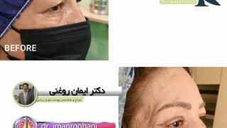 جراحی پلک کامپوزیت ونیر