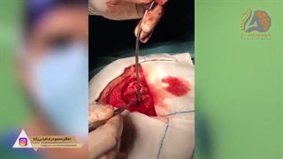 فیلم واقعی جراحی تومور مغزی بیمار در اتاق عمل