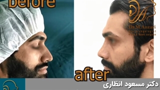 عمل بینی در مردان را ببنید