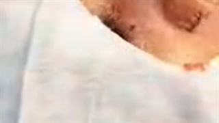 نتیجه جراحی بینی در اتاق عمل