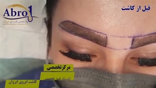 معجزه کاشت ابرو| کلینیک ابروان