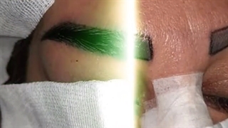 فیلم قبل و بعد کاشت ابرو| کلینیک ابروان