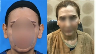 فیلم عمل زیبایی گوش یا اتوپلاستی