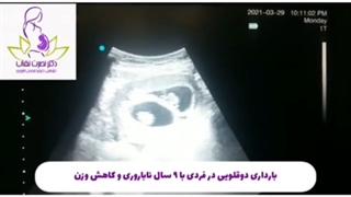 بارداری دو قلویی در فردی با سابقه ۹ سال ناباروری و کاهش وزن
