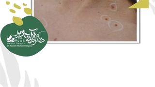 موضوع: برداشت خال