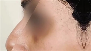 نمونه جراحی زیبایی بینی