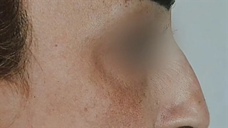 نمونه جراحی زیبایی بینی