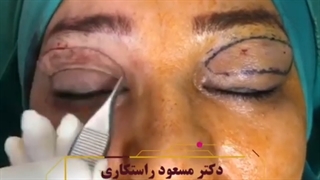 صفر تا صد جراحی بلفاروپلاستی در اتاق عمل
