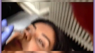 لیفت دوبل بینی با نخ خاردار توسط بهترین دکتر