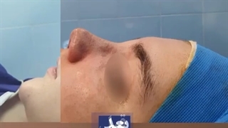 فیلم واقعی عمل بینی توسط دکتر طاهری نیا کامپوزیت ونیر