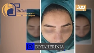 عکس های واقعی از جراحی بینی در اتاق عمل