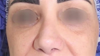 تزریق چربی به صورت بلیچینگ دندان