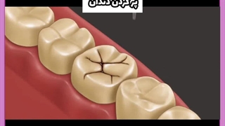 ایا پرکردن دندان خوب است