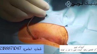 فیلم عمل کیست مویی سنتی در کلینیک نوین
