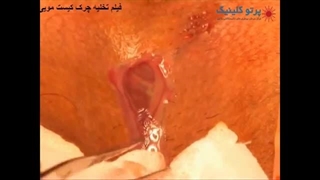 فیلم تخلیه چرک کیست مویی- پرتو کلینیک