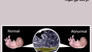 مروری خلاصه بر سونوگرافی ان تی