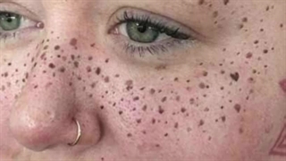 دلیل ایجاد خال سر سیاه چیست و ساده ترین روش درمان خال سر سیاه در خانه