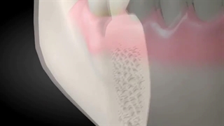 پیوند استخوان