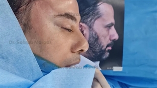 رفع الحاجب بالمنظار للرجال