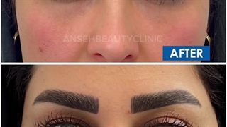 فیلر زیر چشم