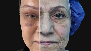 جراحة شد الوجه العمیق