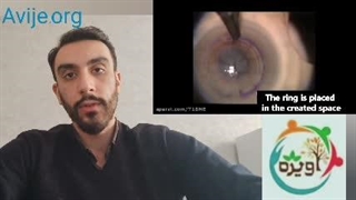 قوانین مربوط به معافیت سربازی قوز قرنیه