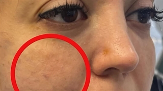 بهترین دکتر لیفت با نخ در اصفهان/ جناب مگ