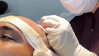 کاشت مو آدرینا قم جناب مگ