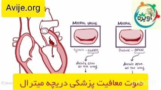 نوع معافیت افتادگی دریچه میترال کدام است؟