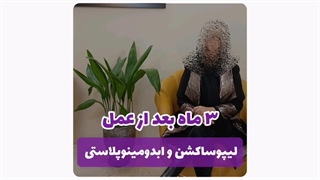 رضایت بعد از عمل ابدومینوپلاستی و لیپوساکشن در مشهد