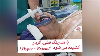 هدرینگ نعل اسبی آنهوما