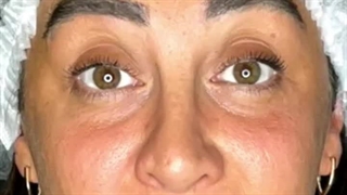 قبل و بعد از تزریق بوتاکس مراجعه کننده زیبا و بسیار دوست داشتنی‌مون